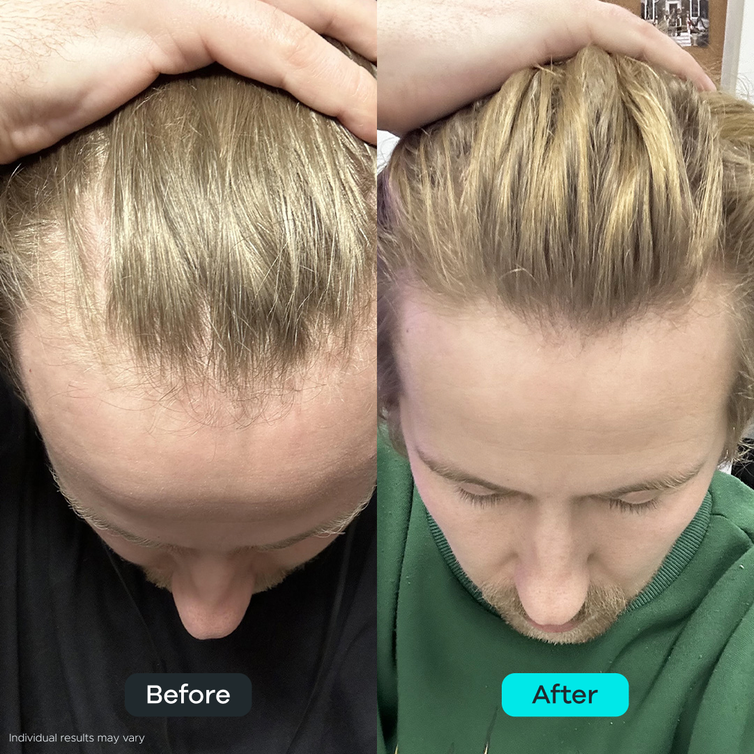 Microfollic™ Hair Infusion System