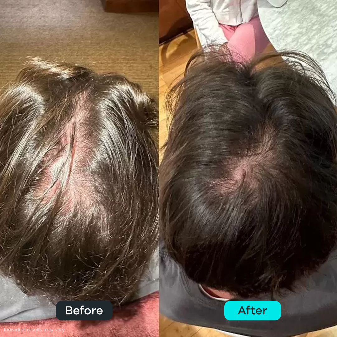 Microfollic™ Hair Infusion System