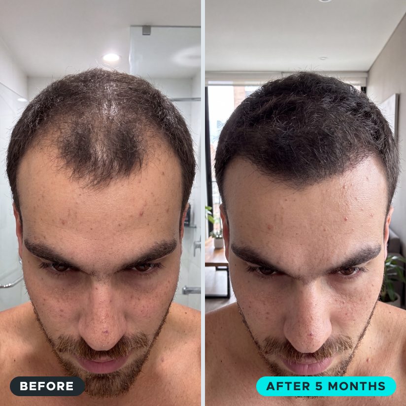 Microfollic™ Hair Infusion System