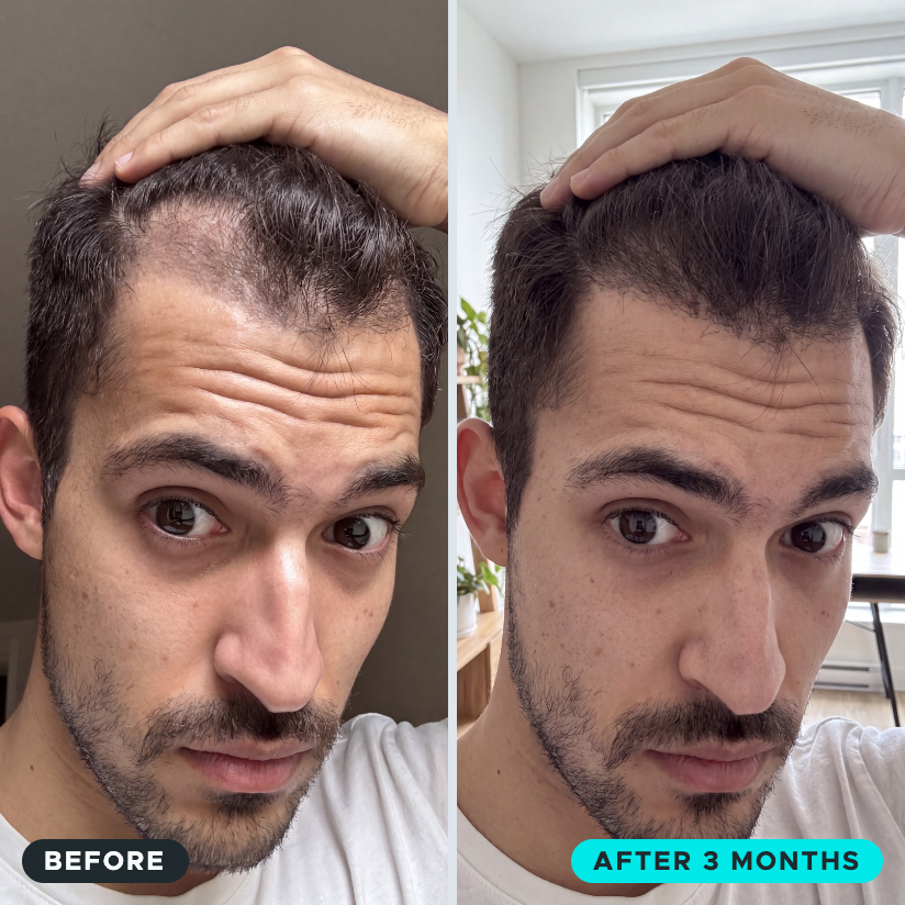 Microfollic™ Hair Infusion System