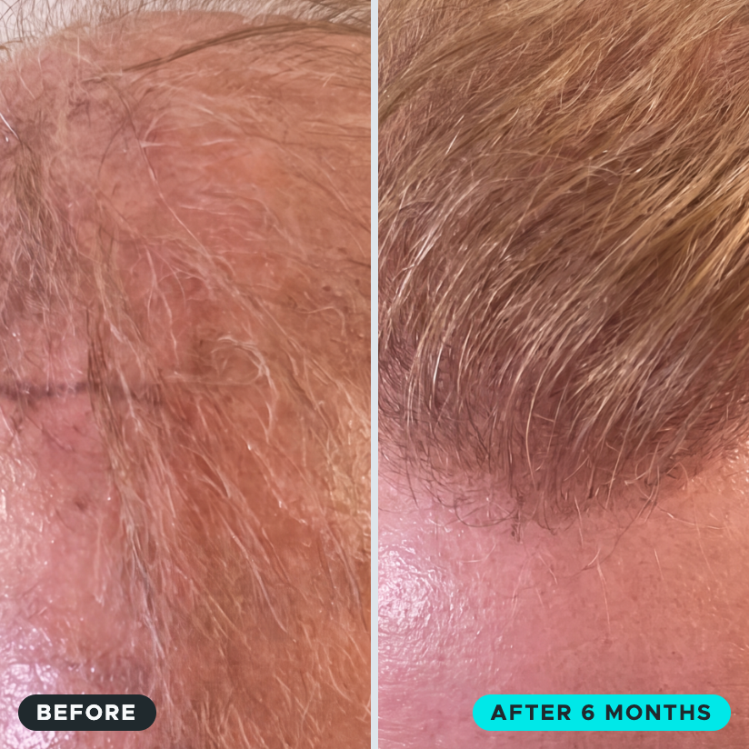 Microfollic™ Hair Infusion System